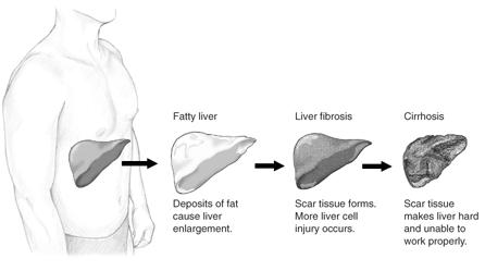 The symptoms of a fatty liver and an efficient recipe to prevent this disease