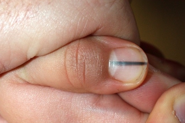A black stripe on your fingernail may be a sign of a severe disease – make sure to see your doctor at once!